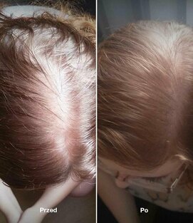 Hermz HairLXR Serum na Rzadkie Wypadające Zniszczone Włosy 150ml